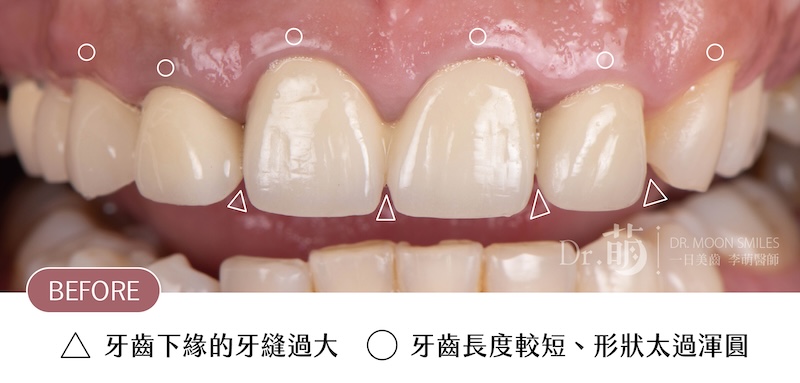療程前王凱的前牙近照,有牙齒下緣牙縫大、牙齒較短且形狀太過渾圓等問題
