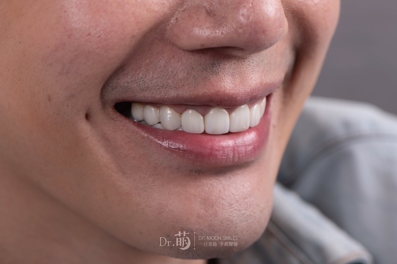 完成台北全瓷冠、陶瓷貼片療程,王凱呈現更完美的笑容