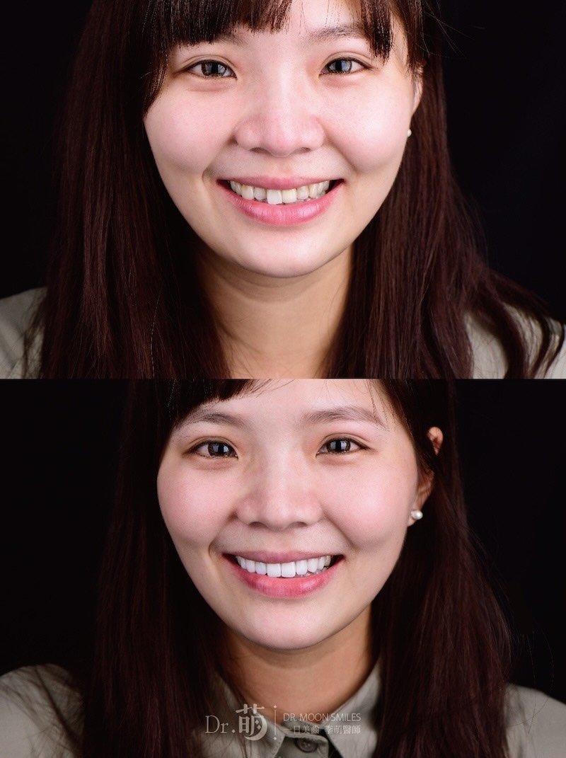 台北全瓷冠、陶瓷貼片療程前後患者笑容對比,改善排列不整、變色以及中線偏斜等問題