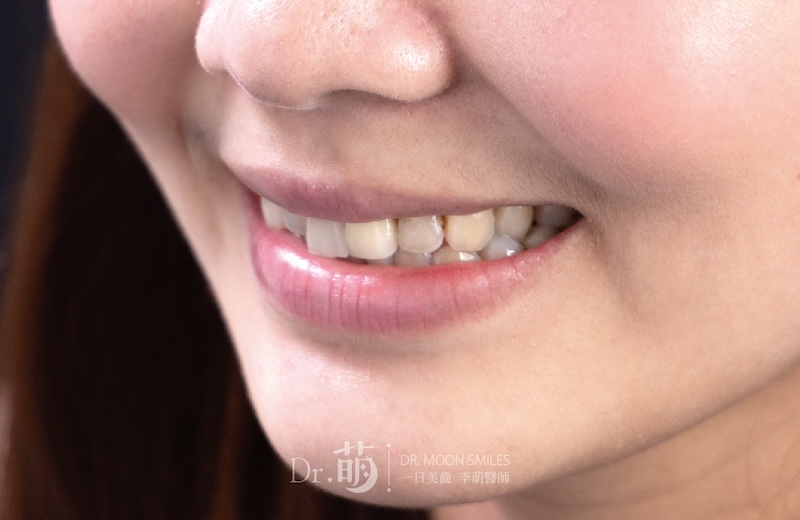 療程前患者的微笑曲線牙齒