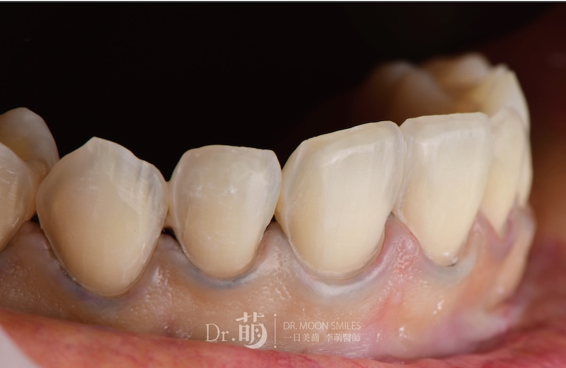 進行微創磨牙後的牙齒外觀