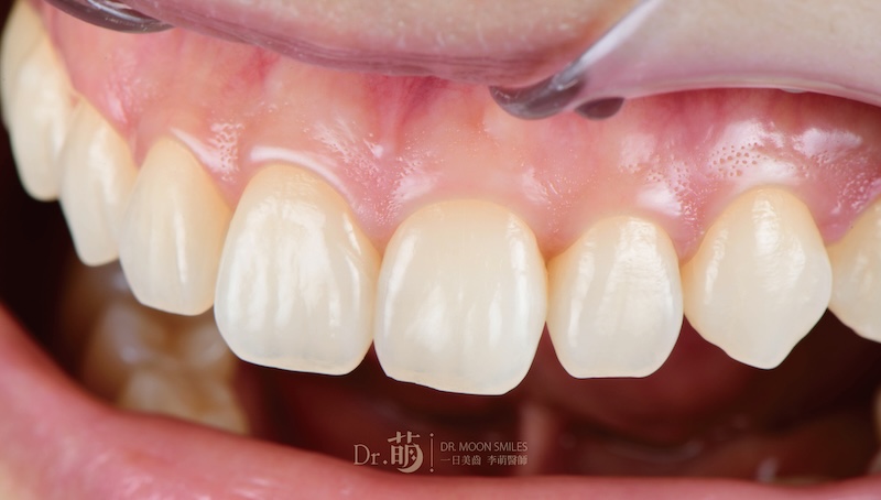 療程前患者牙齒顏色