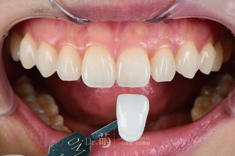 療程前患者牙齒顏色與貼片色階對比