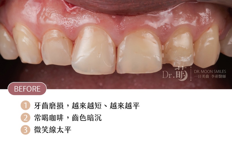 療程前牙齒近照,磨牙導致牙齒短平,伴隨牙齒黃、微笑曲線太平