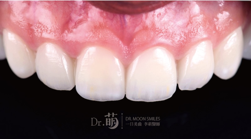 陶瓷貼片上排前牙近照,外觀呈現自然、白、透的效果