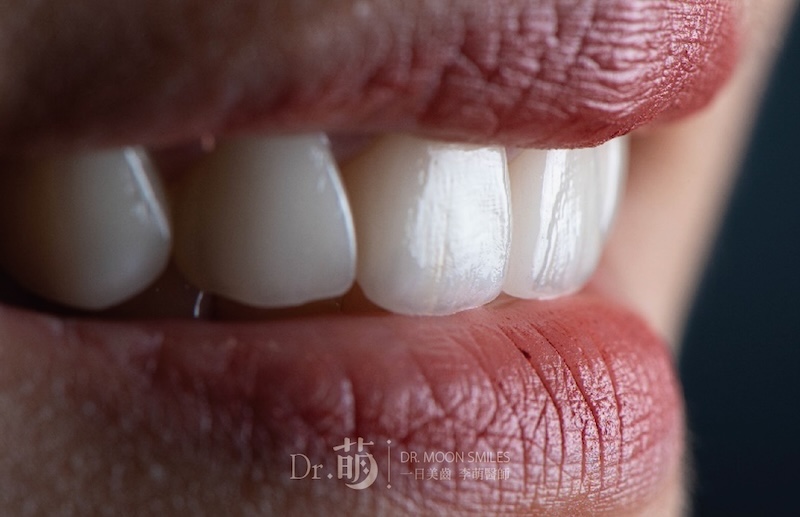 陶瓷貼片牙齒近照,白皙透亮且具有真牙自然紋理