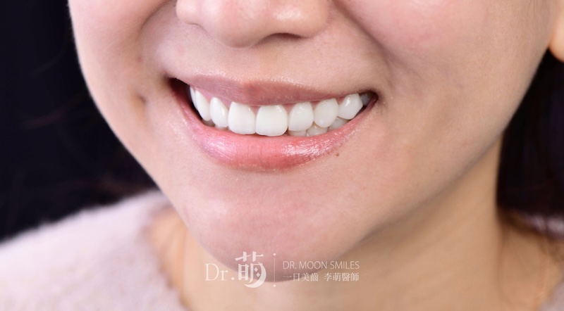 做完陶瓷貼片,患者露出零死角漂亮笑容