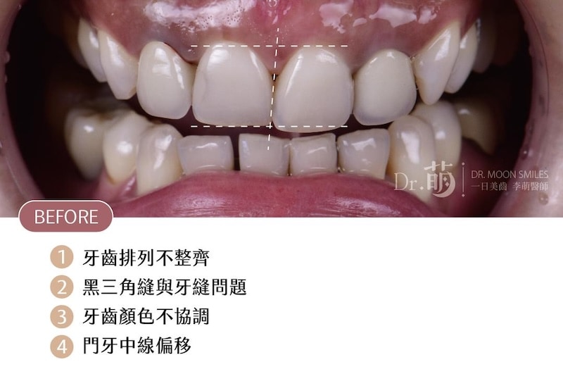 陶瓷貼片術前狀況:牙齒排列不整齊、牙縫黑三角與牙齒中線偏移